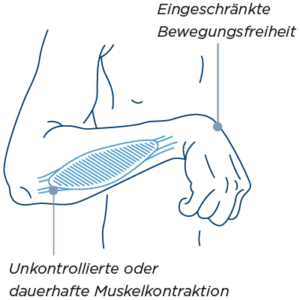 Una mano colpita da una condizione spastica può muoversi appena per via di una contrazione muscolare duratura