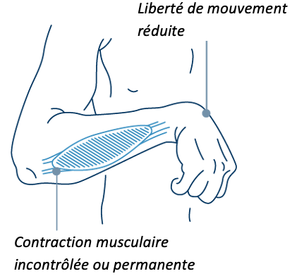La contraction musculaire permanente empêche la main spastique de bouger
